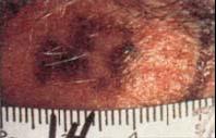 Melanoma a