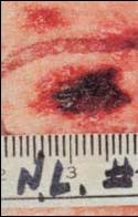 Melanoma b