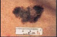 Melanoma c
