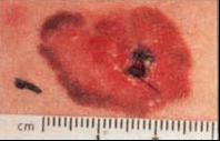 Melanoma d
