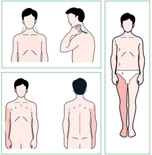 linfedema 01